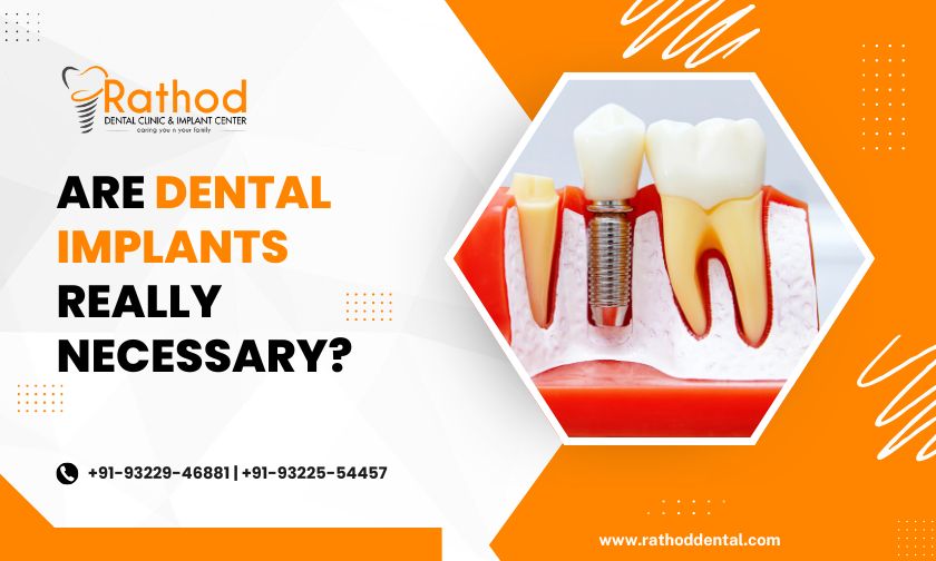 Are Dental Implants Really Necessary