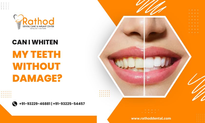 Can I Whiten My Teeth Without Damage