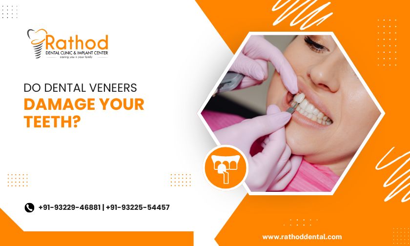 dental veneers in badlapur