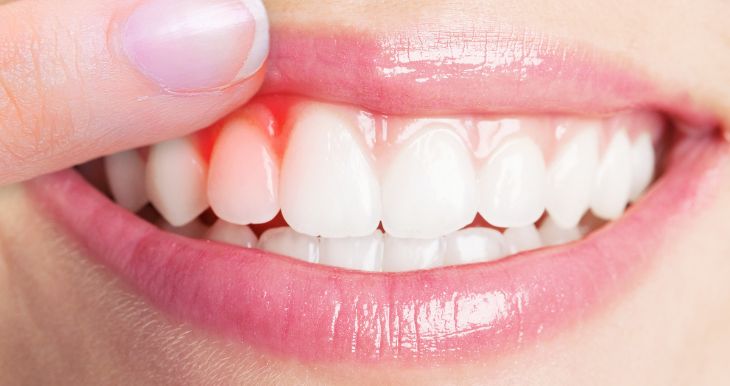 Gum Disease Symptoms Prevention and Treatment
