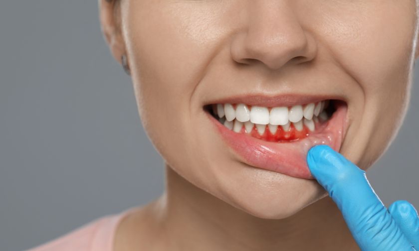 Home Remedies for Bleeding Gums Effective Tips for Relief