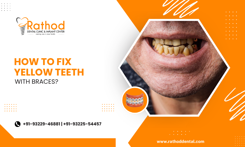 How To Fix Yellow Teeth With Braces?
