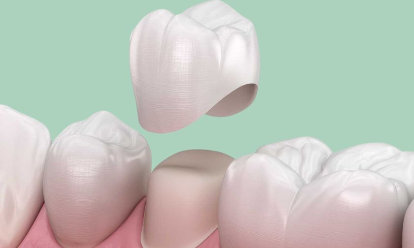 Managing Discomfort During and After Your Dental Crown Treatment