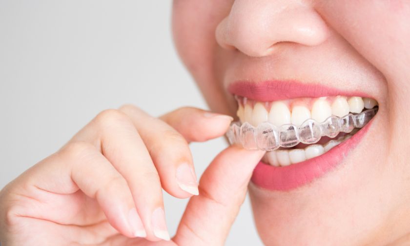 The Benefits of Choosing Invisible Braces for Your Smile Transformation