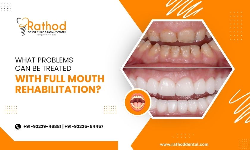 best full mouth rehabilitation in badlapur